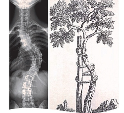csm_Skoliose_f09295542f.jpg